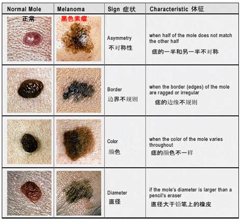 屁股的痣|身上7种痣一定会癌变！